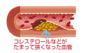 コレステロールなどがたまって狭くなった血管